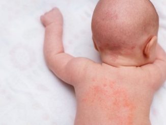 嬰兒熱疹 嬰兒熱疹